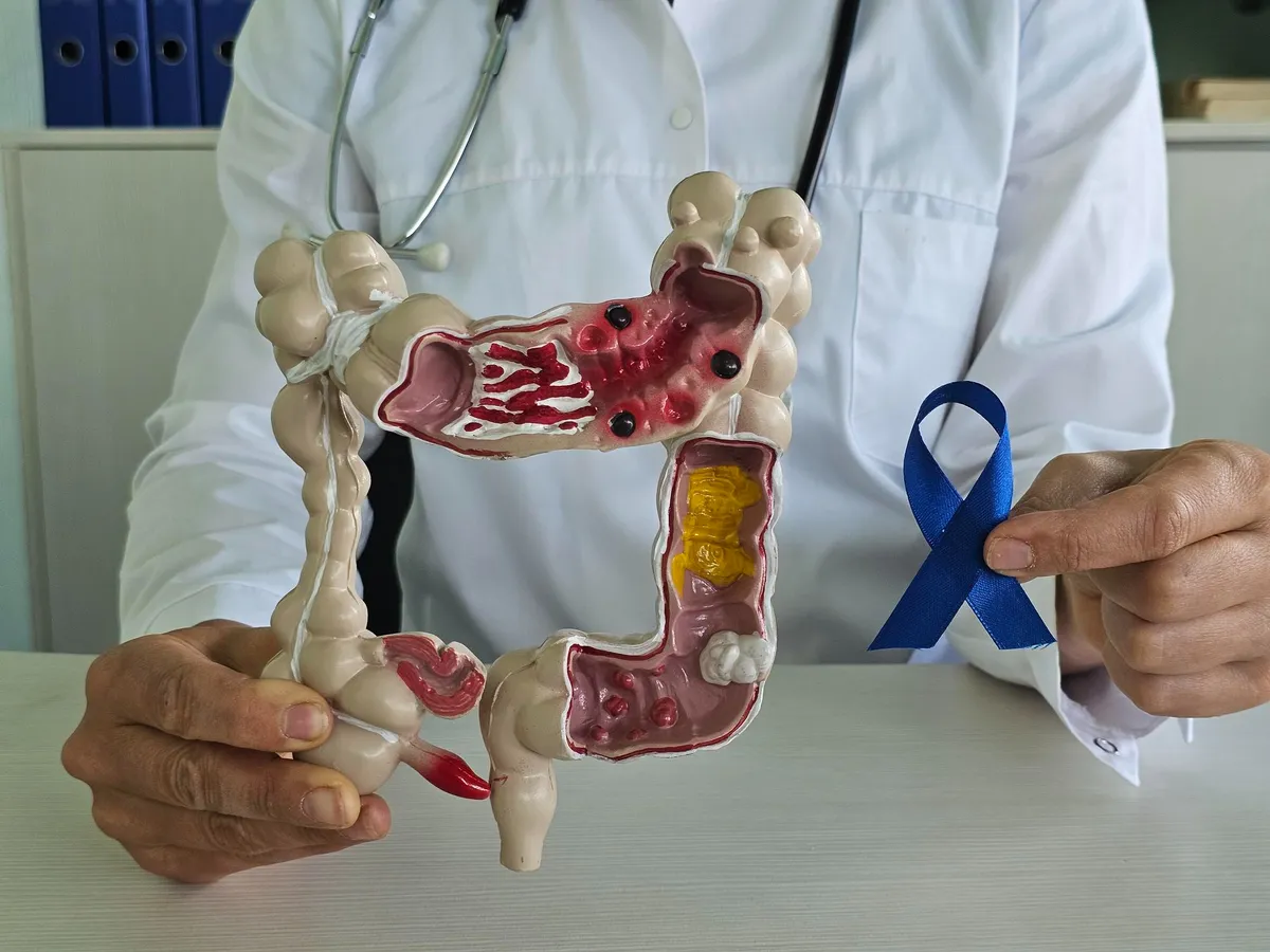 Medic prezentând un model anatomic al colonului și panglica albastră pentru conștientizarea cancerului colorectal